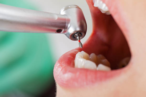 Best Emergency Dental Care for Abscessed Tooth in Highlands, CA